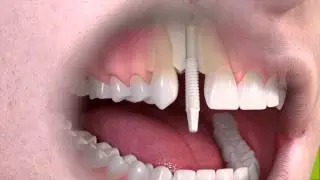 Straumann - Ceramic implant-borne single-tooth treatment