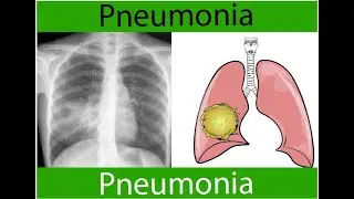 Pneumonia  Part 1