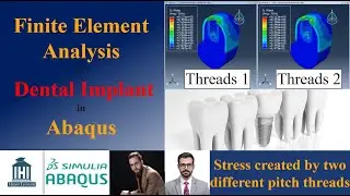 Finite Element Analysis of Dental Implant in Abaqus