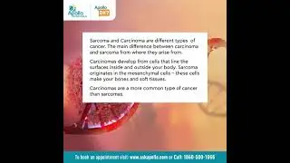 What is the difference between a Sarcoma and Carcinoma? | Apollo Hospitals