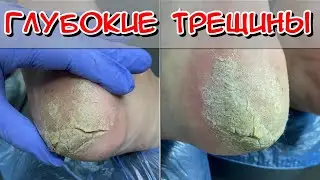 Глубокие трещины / 