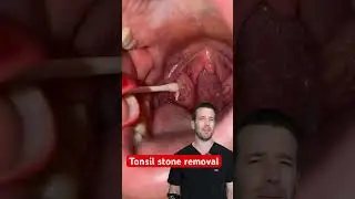 Tonsil Stone Be Gone! 