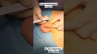Penile enlargement surgery Penis surgery Dr Araz Bayramov penilenlargement.com 