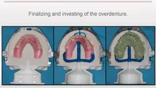 Clinical Case: LOCATOR R-Tx by Nadim Baba, DDS