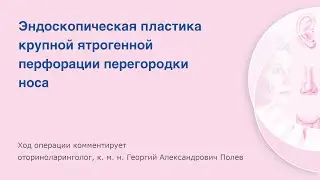 Эндоскопическая пластика крупной ятрогенной перфорации перегородки носа