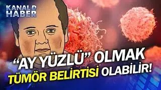 "Ay Yüzlü" Olmak Sandığımız Kadar İyi Değil! Tümör Belirtisi Olabilir...