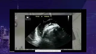 SUN 14 35 Felipe Teran – TEE During Cardiac Arrest