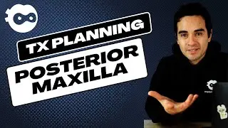 Implant Treatment planning for the Posterior Maxilla