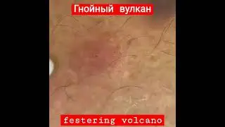 гнойный вулкан  #чистота #рекомендации #уход