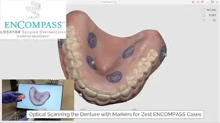 ENCOMPASS Step 3: Optical Scanning the Denture with Markers for Zest ENCOMPASS Case Workup
