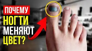 КАКИЕ ЕСТЬ БОЛЕЗНИ НОГТЕЙ? ДИСТРОФИЯ! Виды и Советы! (Подолог РЕКОМЕНДУЕТ!)