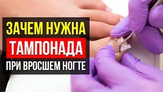 ТАМПОНАДА НОГТЕЙ. Что Это За Процедура? Какие Материалы используются?