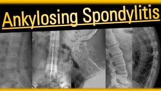 Ankylosing Spondylitis 