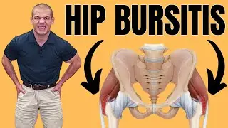 Pain in Both Hips? Discover Relief from Bilateral Trochanteric Bursitis