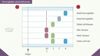 Hemoglobin electrophoresis