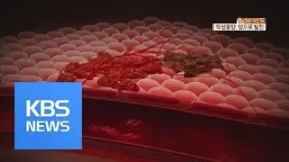 [5분 건강 톡톡] ‘암’에 대한 오해와 진실 / KBS뉴스(News)