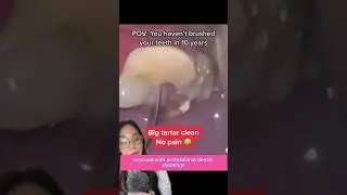 10 year tartar build up. 