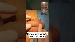 Dermal burn penis🔥 Stem Cell therapy in Andrology Dr Araz Bayramov penilenlargement.com