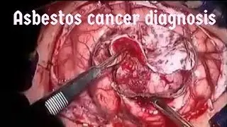 Cancer asbestos mesothelioma