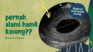 Pernah Alami Hamil kosong? Ini penyebab blighted ovum