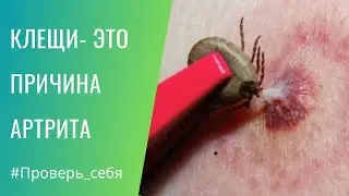 Клещи и ревматоидный артрит. Как проверить себя #анализы