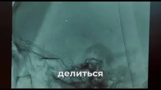 Инсульт