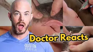 Doctor reacts to Viral TikToks - Pimple Popping, Cyst Popping