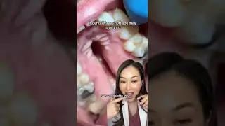 Extra bone growth on the roof of the mouth. #bonegrowth #bone #mouth #tori #extrabone