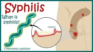 Syphilis | Syphilis - Pathophysiology | Diagnosis of Syphilis | symptoms and Treatments of Syphilis