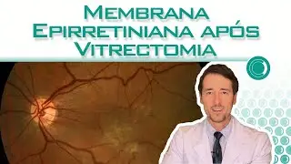 Membrana epirretiniana após vitrectomia é normal?