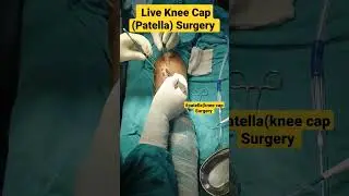 How Live Knee Cap patella Surgery Done | 