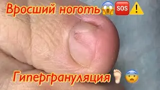 Вросший ноготь😱🆘⚠️ • Гипергрануляция🦶🏻😨