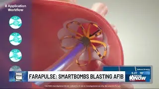 Medical Moment: Smartbombs blasting AFib