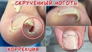 Скрученные ногти / Установка титановой нити
