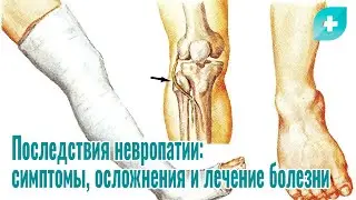 Последствия невропатии: симптомы, осложнения и лечение болезни