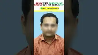 HOW BEAUTIFUL HAIR TRANSPLANT RESULT I GOT 