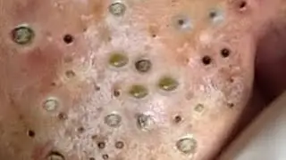 Blackheads & Whiteheads Satisfying Removal @0253