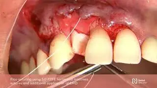 Guided bone regeneration with simultaneous implant placement