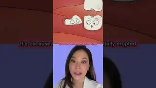 Bad Breath from a Wisdom Tooth 