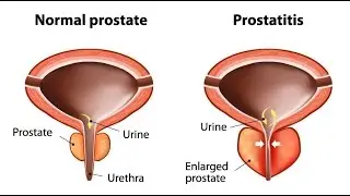 Prostatitis