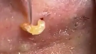 Removal Blackheads Sac Dep Spa #blackheads #acne #pimple