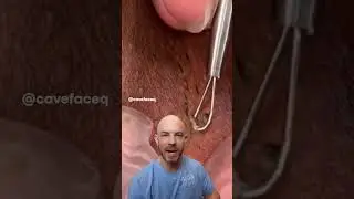 Armpit cyst and ingrown hair removal 😰 #dermreacts #doctorreacts #ingrownhair #satisfying #cystpop