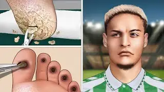 [ASMR Animation] So Satisfying! Foot care for Antony | Calluses, Plantar Warts