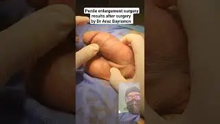 Penile enlargement surgery results after surgery by Dr Araz Bayramov 