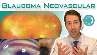 Glaucoma neovascular nas doenças da retina.