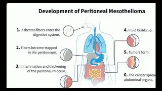 Mesothelioma Attorney | Top Mesothelioma Law Firms | mesothelioma Personal Injury Lawyers