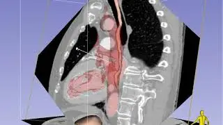 Mid-Esophageal 2-Chamber Imaging Plane in TEE - Standard View